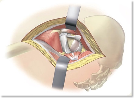 480-approaches-posterior