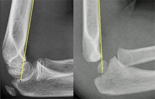 anterior humeral line