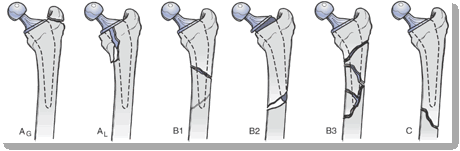 Periprosthetic Fractures