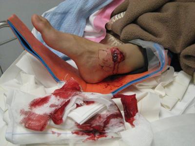 painful-tendon-after-severe-ankle-fracture-21312561
