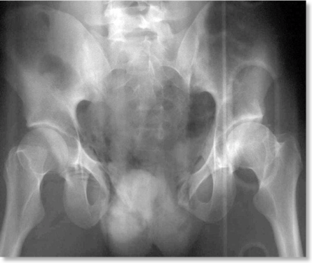 Pelvic Fractures