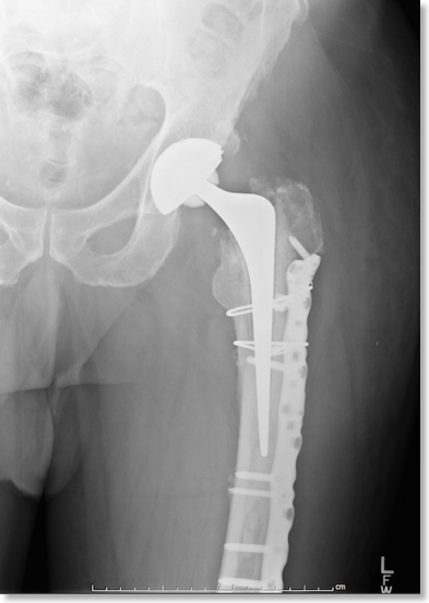 Core Othopaedic Knowledge: Periprosthetic Hip Fractures | ST3