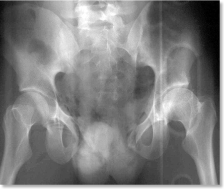 Pelvic Fracture Imaging: Practice Essentials, Computed Tomography,  Radiography